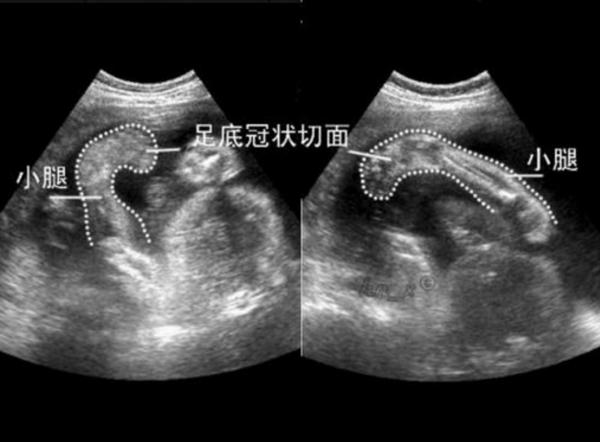 孕期大排畸检查发现胎儿双足内翻!留还是流?这位妈妈太明智!