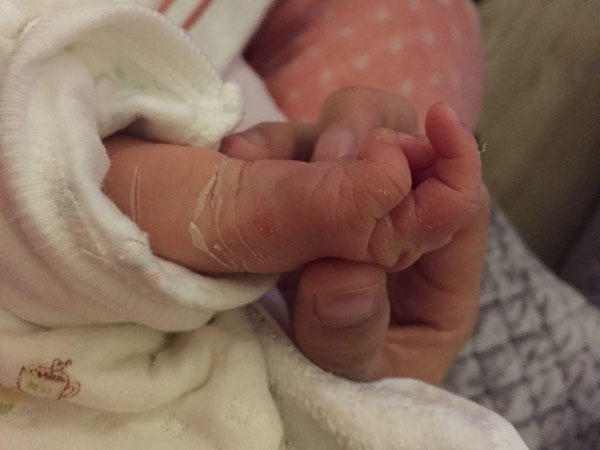 新生宝宝脱皮不用慌 这是宝宝的成长