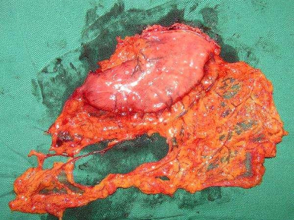 家族中有肿瘤疾病史和家族胃癌史;患有胃息肉;接受过胃部手术;有多年