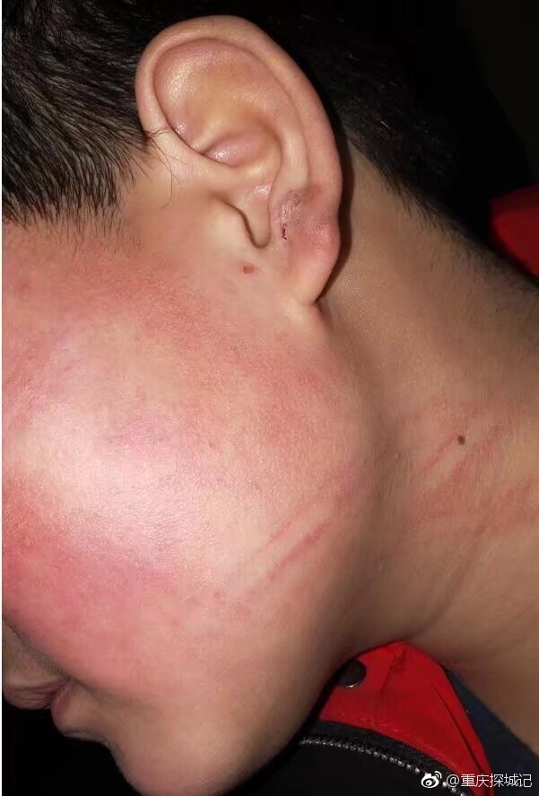 熄灯后吵闹 学生被宿管竹荆抽打脸部