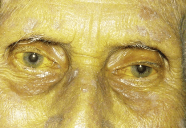 出现黄疸不一定是肝病的表现,这两种类型你或许不了解!