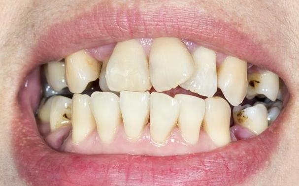 牙齿表面有一层软软的发黄物,导致牙发黄,用对这4招牙齿变亮白