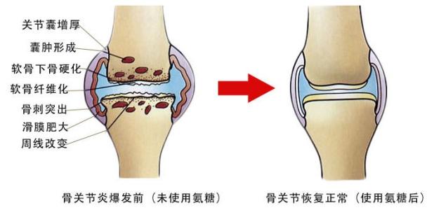 中医秘方逼走了爷爷10年的滑膜炎!三天就见效