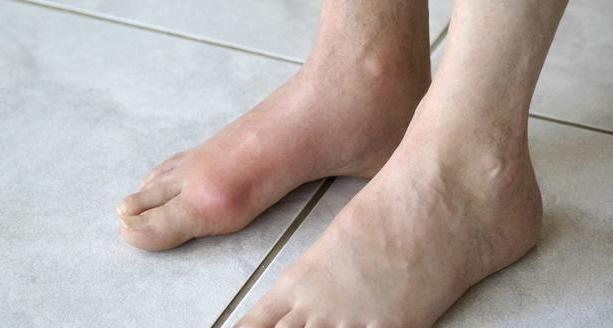 这3大食物能闻风而动,瓦解痛风轻而易举