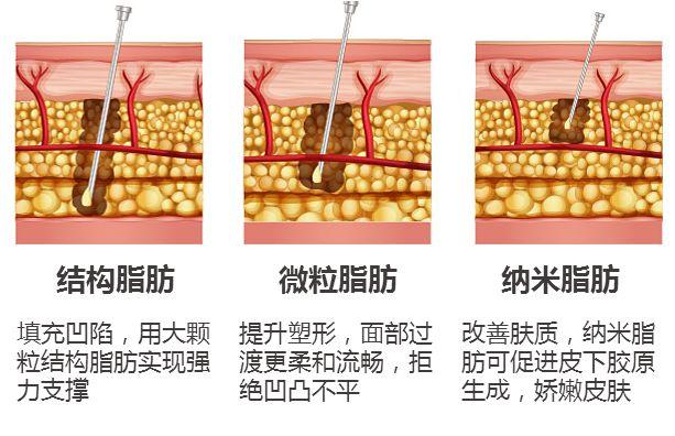 【邱立东自体脂肪面部填充】