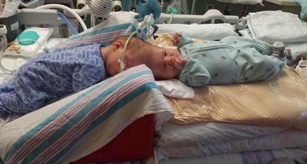 连体婴儿奇迹般存活!24小时手术没有压倒双胞胎!