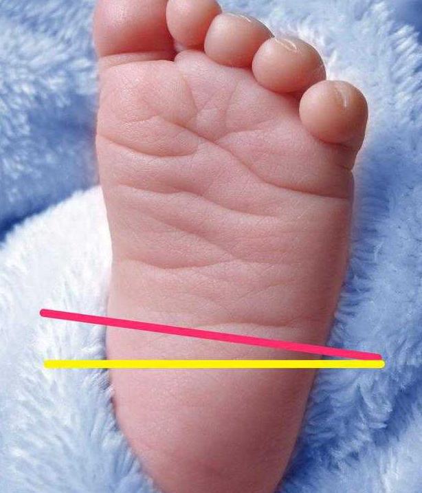 宝宝1岁之前都是o型腿36岁是x型腿这种说法是真的吗