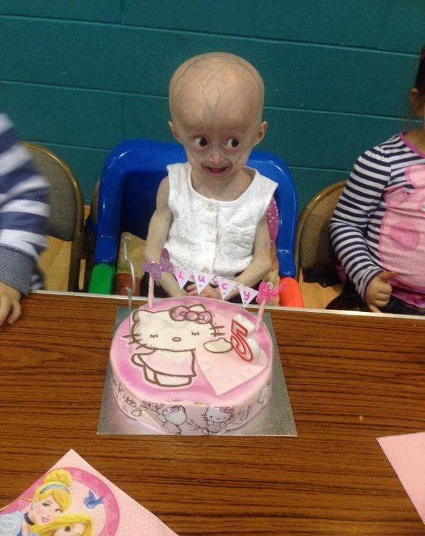 国外早衰女孩,8岁看着像是60岁,看着真让人心酸|女孩|早老症|早衰症