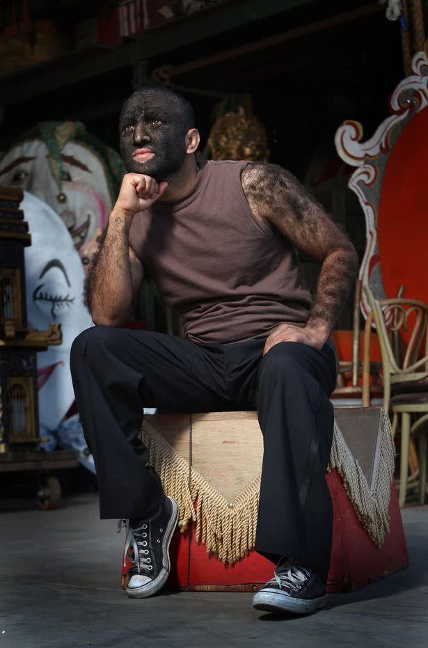 芝加哥体毛最多的"狼人"接受采访,生活艰难但我在努力