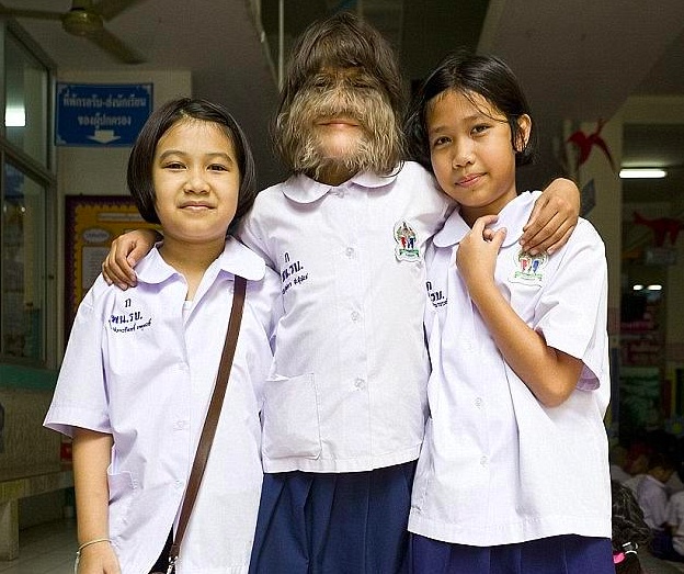 17岁女孩患上"狼人症候群",找到真爱露出真面貌!