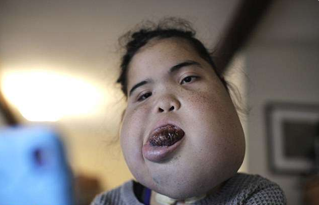 畸形女婴被断言不会活过2岁,她的成长经历,打了医生的脸!