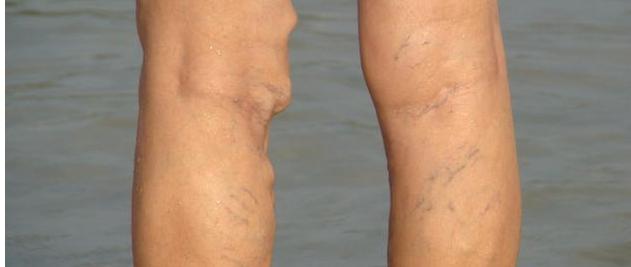 小腿出现3大症状,说明血管动脉硬化严重,不想双腿报废就看过来