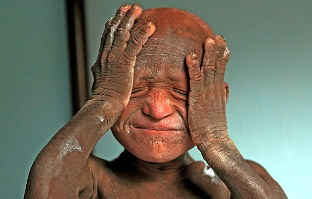 石化男孩的艰辛成长路不能说不能走这样的童年好心酸