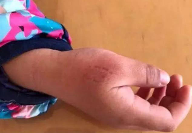 孩子咬伤了别的小朋友,家长还理直气壮说是幼儿园的责任!