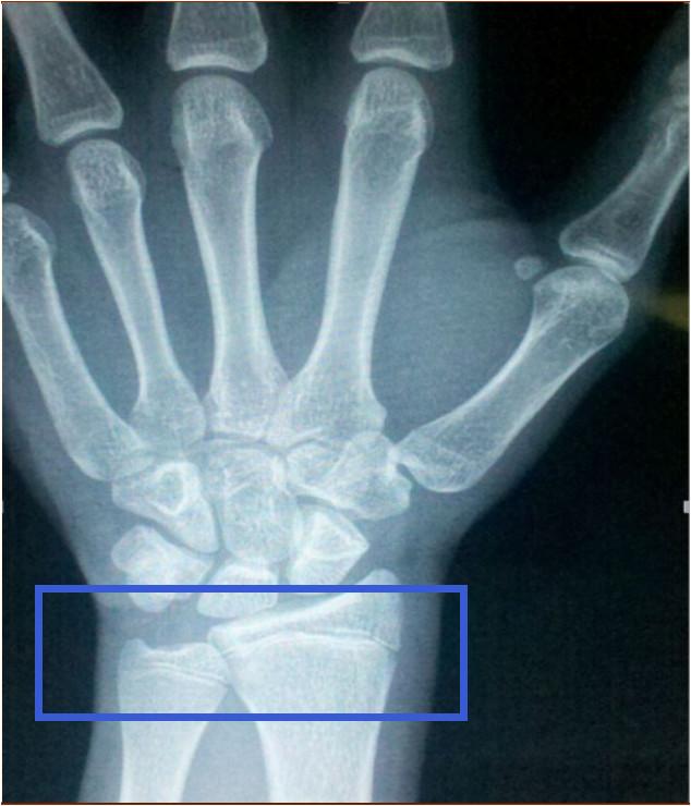 一两年身高没有变化是不是代表着骨垢线已经闭合了