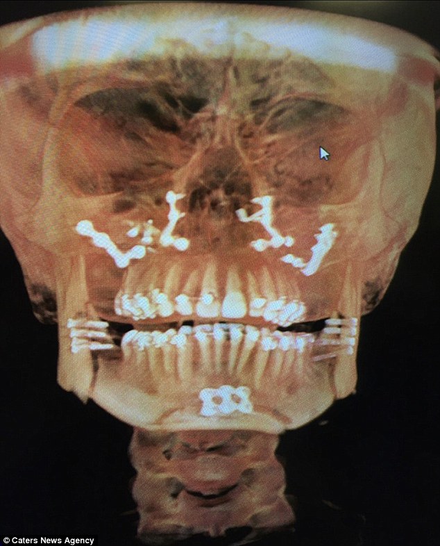 由于她的下颌畸形,佩戴矫正牙套给她带来了更多的痛苦和折磨.
