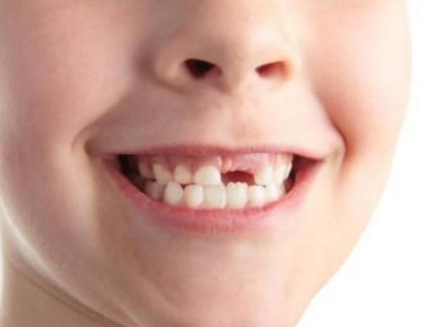 乳牙不健康会影响恒牙吗?听听牙科专家邓医生怎么说