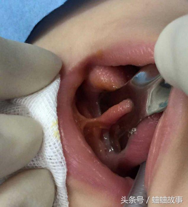 医生了解了情况后,就让孩子张开嘴巴,这时候医生发现孩子的舌系带过短