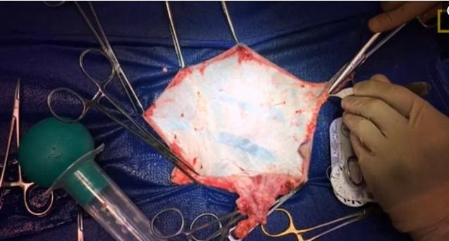 男子变性手术过程全揭秘, 变性成功后他和昔日妻子成闺蜜