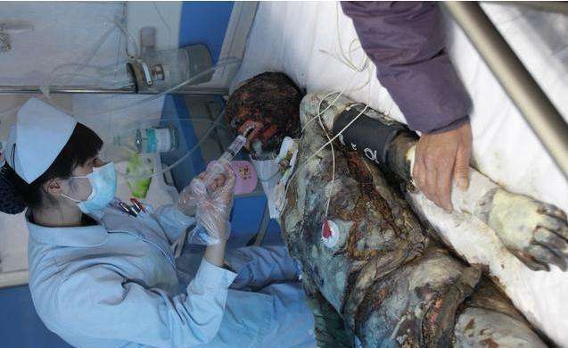 10岁孩子上课时突然出现嘭的一声孩子的脸双手被炸伤了