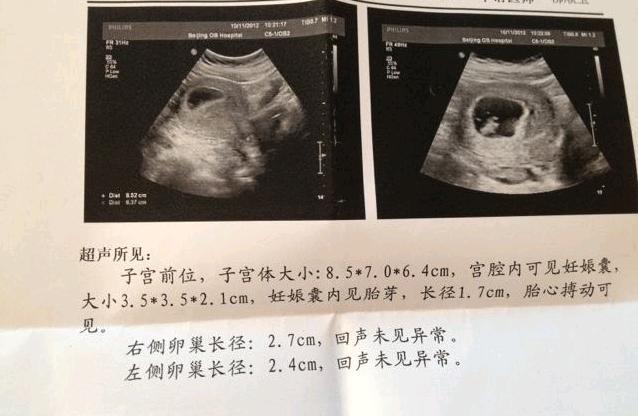 b超没有胎心胎芽先不要过早决定引产要不然可能后悔一生