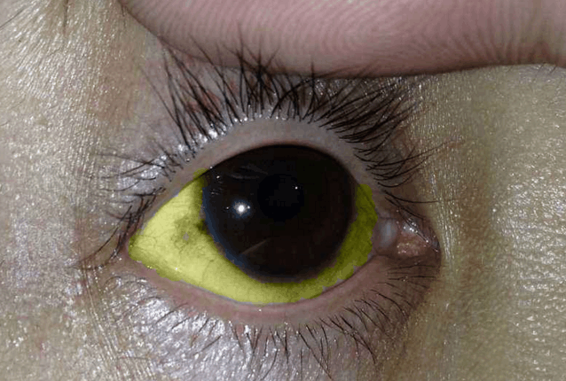 黄疸婴儿眼睛发黄照片图片