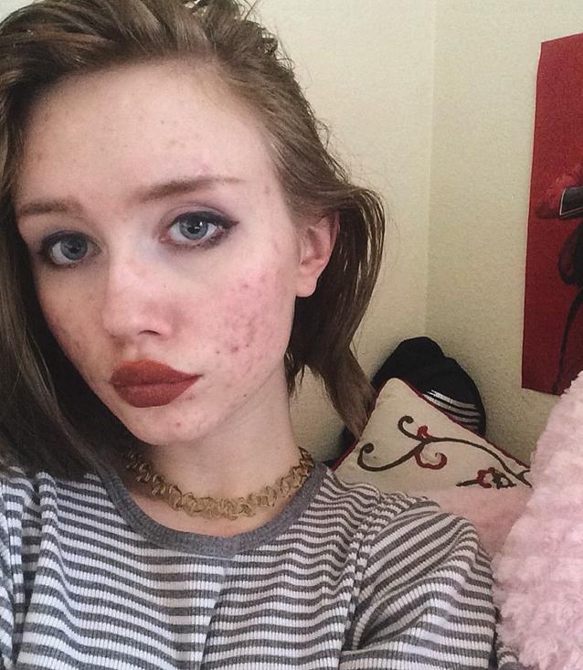 美国女孩满脸粉刺仍自信展现缺陷美