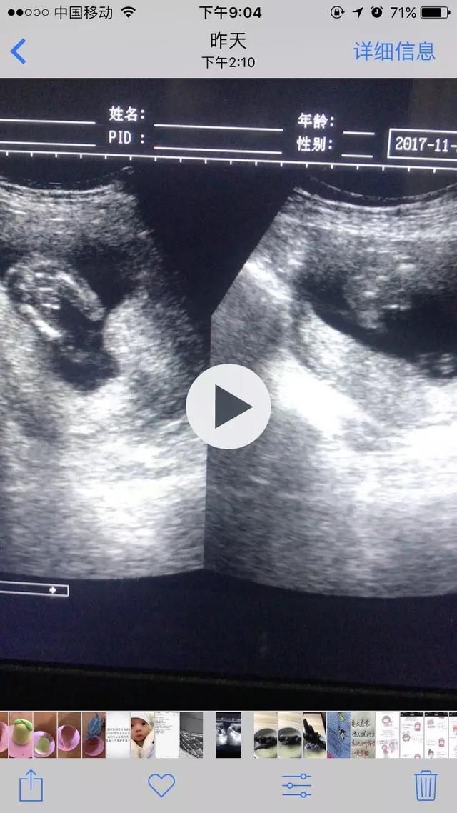 好幸运,二胎16周早早得就确定是男孩,孕期这些男宝症状太明显了