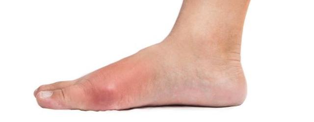 大脚趾疼痛,是痛风的首发症状,不以为意小心造成残疾