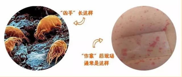 三月不晒被百万螨虫陪你睡天气回暖警惕螨虫导致皮肤病