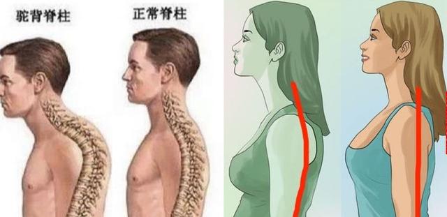 长大后的驼背,竟是爸妈抱出来的!