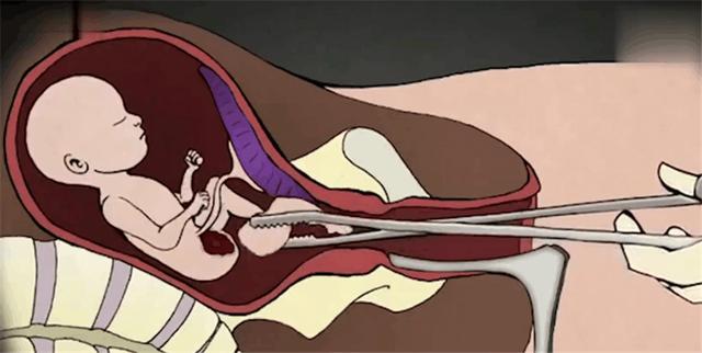 是无限大的(很多人宝妈,老人也在指责引产是一种有损人道主义的手术)