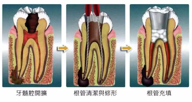 牙齒|周炎|根尖_新浪新聞