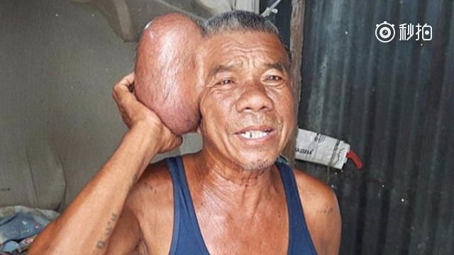 老汉脑袋长巨瘤形似双头怪 被路人一照捧红重获新生