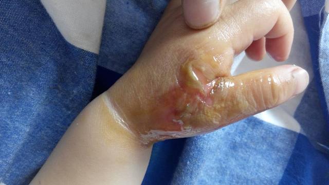 宝宝被烫伤时的应急处理措施