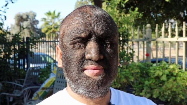 现实版狼人98的身体覆盖着毛发是世界上毛发最旺盛的人