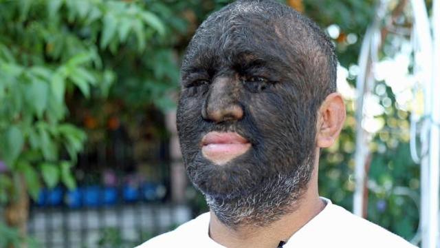 现实版狼人98的身体覆盖着毛发是世界上毛发最旺盛的人