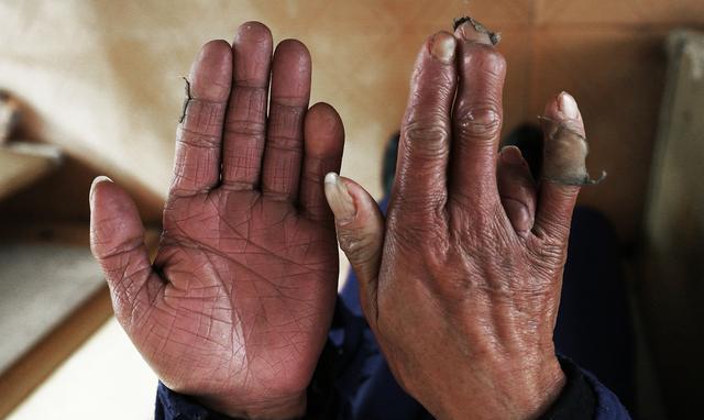 残疾母亲打工,做针线替儿子还债,手被针扎出血洞,儿子却不领情