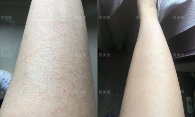 正文 本人腿部皮肤干燥,起皮,掉屑…没到医院诊断过…怀疑是遗传