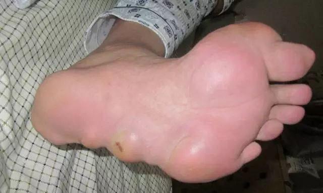 石头|右脚|痛风_新浪新闻