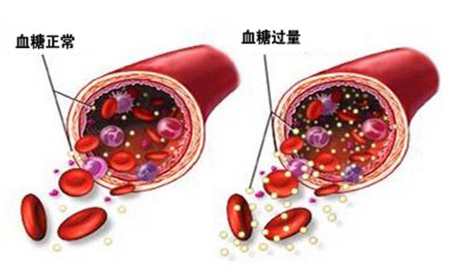 血糖高了如何降?做好自我降血糖三部曲,血糖平稳到80岁