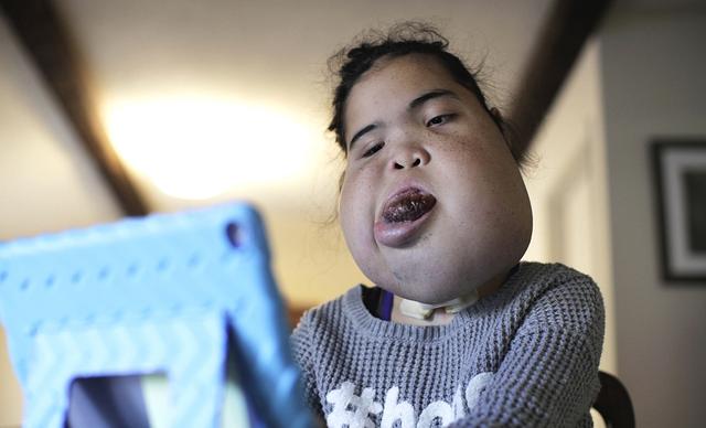 美国女孩面部肿大无法正常说话进食 但她却活得很精彩