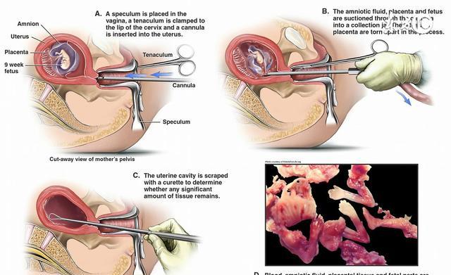 你的堕胎史怎样才能瞒过产检医生?|产检|堕胎|医生_新浪新闻