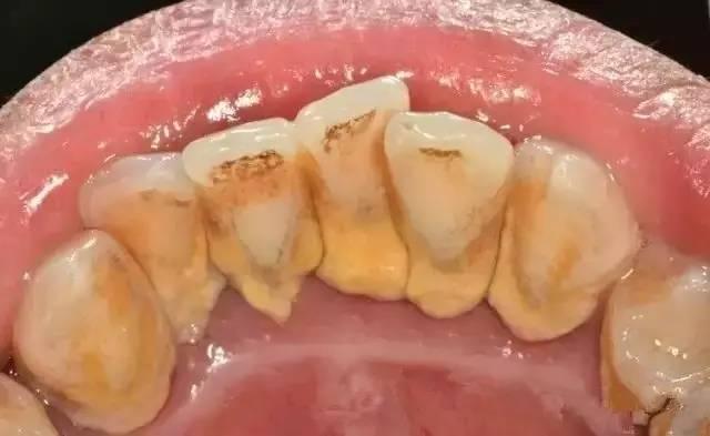 牙结石还会长在牙龈里面及时清除否则后患无穷