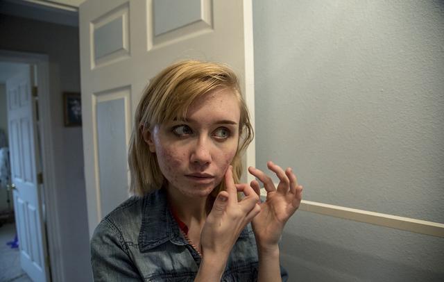 美国女孩满脸粉刺仍自信展现缺陷美