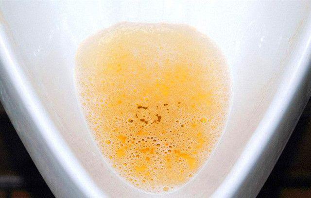 尿毒症早期, 身体会出现这5个症状, 大意不得