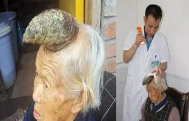 老妇人的头上活生生长了一只"角"出来?据儿子说法,现在还在长