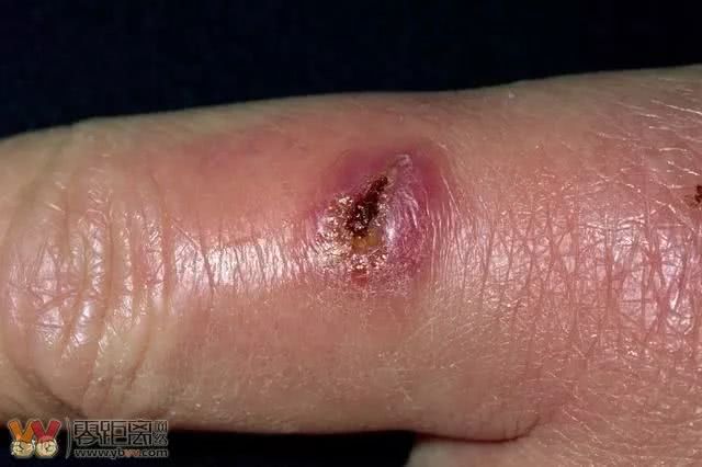 26岁小伙以为感冒,检查结果一出来,9个女孩立刻赶到医院…|艾滋病