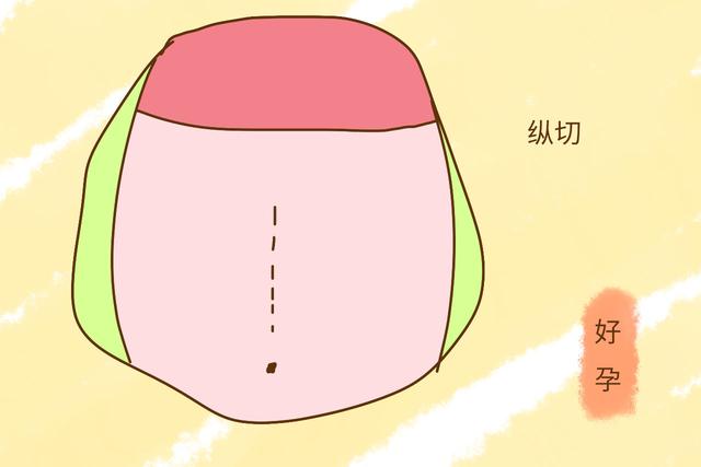胎是剖腹产,第二胎还能顺便产吗