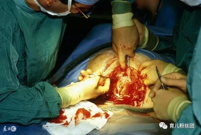 90孕妇5年剖3次, 医生看到子宫手颤, 护士: 很像"沼泽泥"!